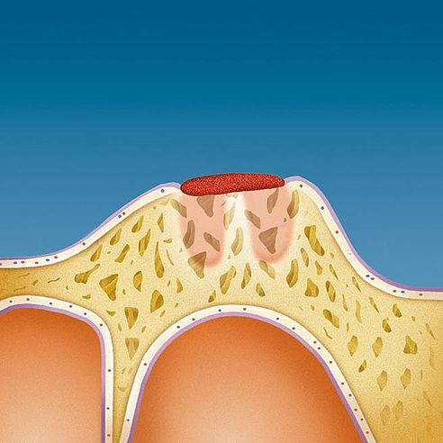 Результатом втрати зубів є глибока рана на Вашій щелепі, вкрита захисним слизовим бар’єром| Protefix.
