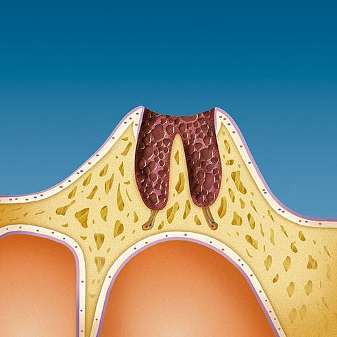 Результатом втрати зубів є глибока рана на Вашій щелепі, вкрита захисним слизовим бар’єром | Protefix